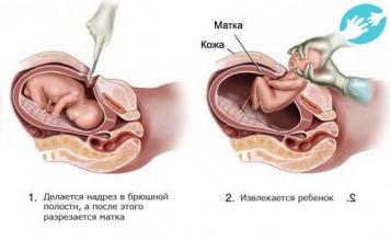 Как протекает беременность после кесарева сечения и возможны ли естественные роды Легко ли забеременеть после кесарева