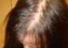 Какими продуктами лечить выпадающие волосы в домашних условиях Как избавиться от выпадения волос народными средствами