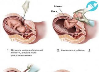 Как протекает беременность после кесарева сечения и возможны ли естественные роды Легко ли забеременеть после кесарева